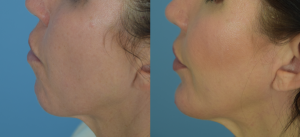 Chin Implant Before & After Patient Miniature Set