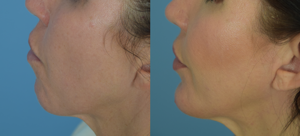 Photo of the patient’s face before & after the Chin Implant surgery. Set 1: Patient 2