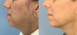 Chin Implant Before & After Patient Miniature Set