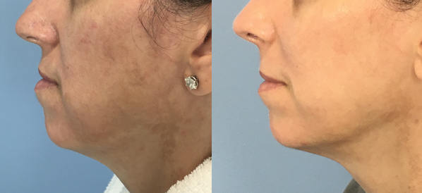 Chin Implant Before & After Patient Set