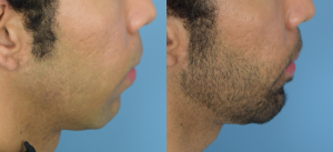 Chin Implant Before & After Patient Miniature Set