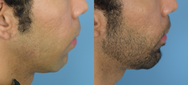 Photo of the patient’s face before & after the Chin Implant surgery. Set 2: Patient 3