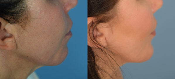 Photo of the patient’s face before & after the Chin Implant surgery. Set 2: Patient 2