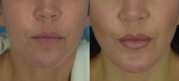 Photo of the patient’s face before & after the Chin Implant surgery. Set 3: Patient 2