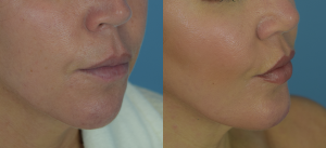 Chin Implant Before & After Patient Miniature Set