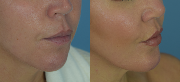 Chin Implant Before & After Patient Set