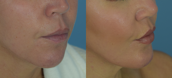 Photo of the patient’s face before & after the Chin Implant surgery. Set 4: Patient 2