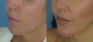Chin Implant Before & After Patient Miniature Set