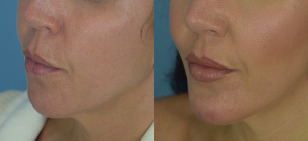 Chin Implant Before & After Patient Set
