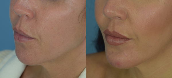 Photo of the patient’s face before & after the Chin Implant surgery. Set 5: Patient 2