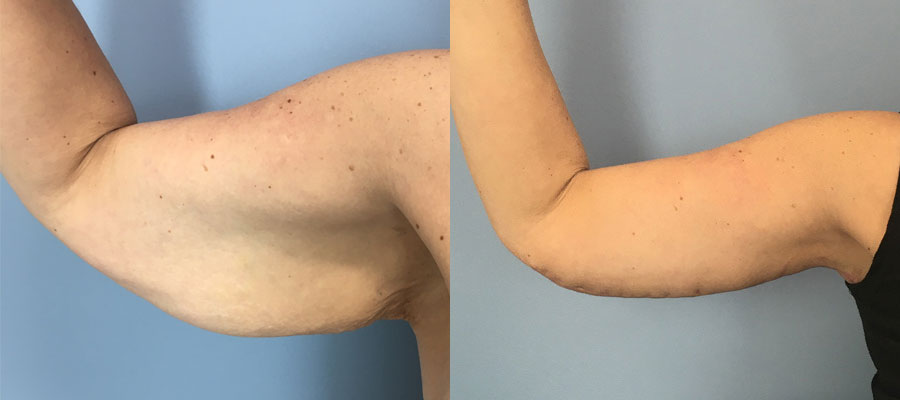 Photo of the patient’s arms before & after the arm lift surgery. Set 1: Patient 1