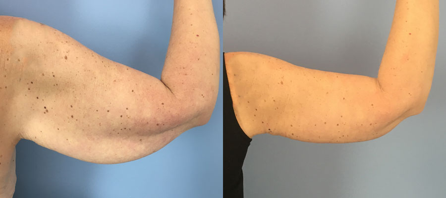 Photo of the patient’s arms before & after the arm lift surgery. Set 2: Patient 1