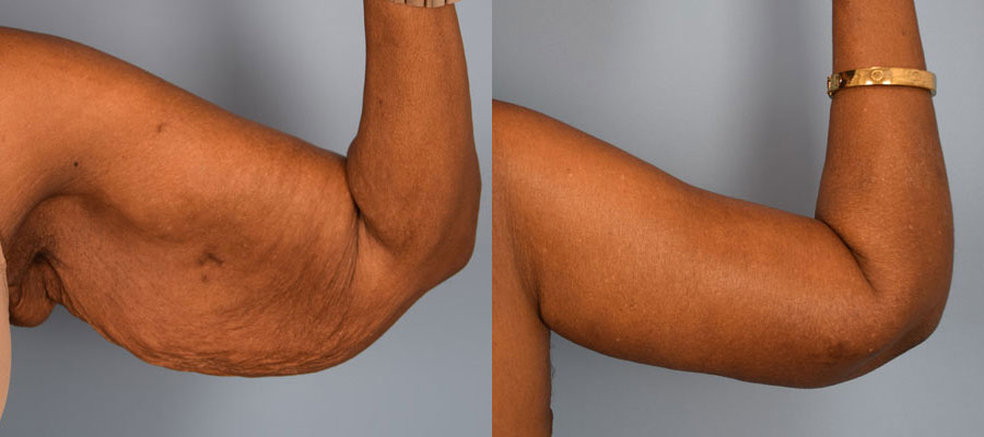 Photo of the patient’s arms before & after the arm lift surgery. Set 1: Patient 2