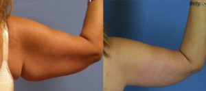Arm Lift Before & After Patient Miniature Set