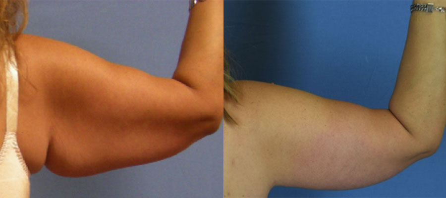 Photo of the patient’s arms before & after the arm lift surgery. Set 1: Patient 3