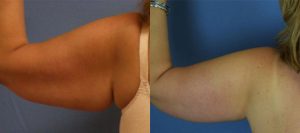 Arm Lift Before & After Patient Miniature Set