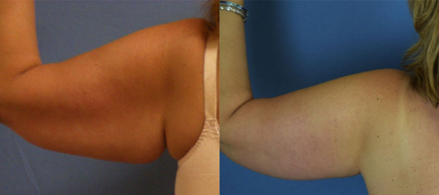 Photo of the patient’s arms before & after the arm lift surgery. Set 2: Patient 3