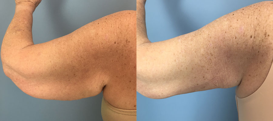 Photo of the patient’s arms before & after the arm lift surgery. Set 1: Patient 4
