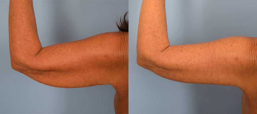 Photo of the patient’s arms before & after the arm lift surgery. Set 1: Patient 5