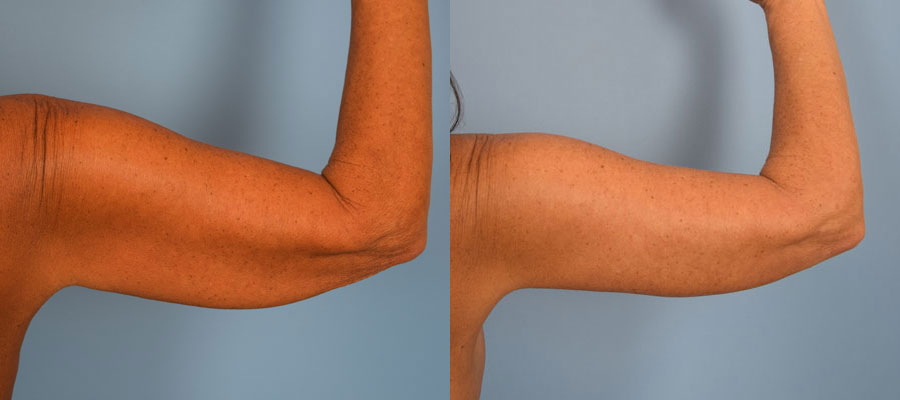 Photo of the patient’s arms before & after the arm lift surgery. Set 2: Patient 5