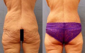 Body Lift Before & After Patient1