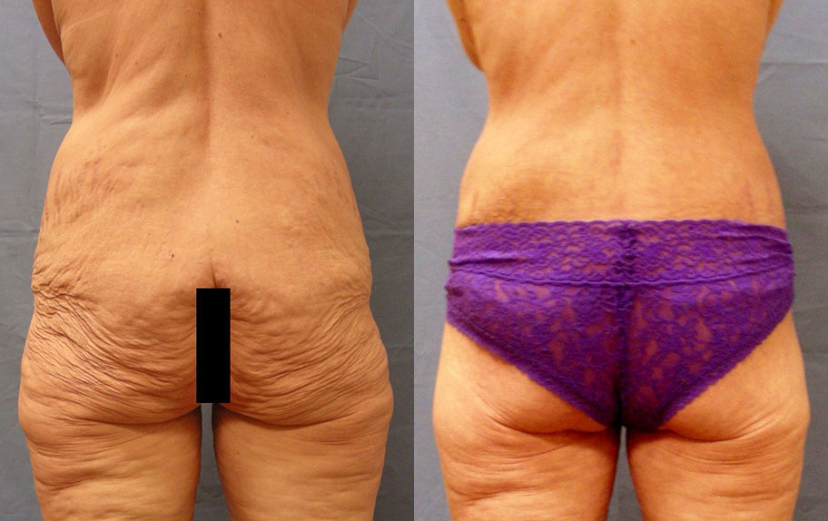 Photo of the patient’s body before & after the Body Lift surgery. Set 1: Patient 1