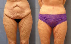 Body Lift Before & After Patient Miniature Set