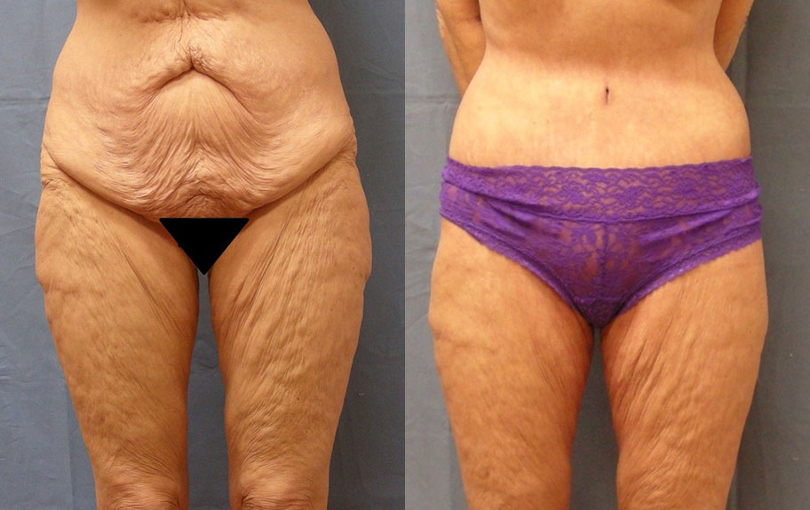 Photo of the patient’s body before & after the Body Lift surgery. Set 2: Patient 1