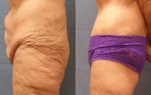 Body Lift Before & After Patient Miniature Set