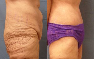 Body Lift Before & After Patient Miniature Set