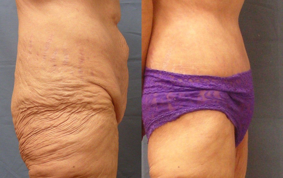Photo of the patient’s body before & after the Body Lift surgery. Set 4: Patient 1