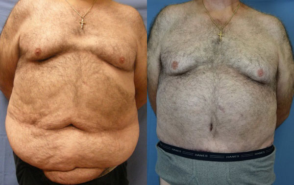 Photo of the patient’s body before & after the Body Lift surgery. Set 1: Patient 2