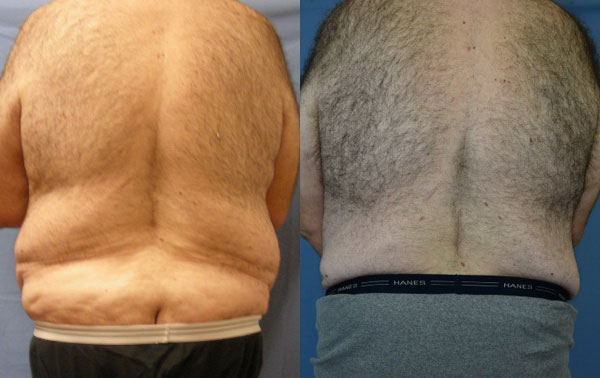 Photo of the patient’s body before & after the Body Lift surgery. Set 2: Patient 2