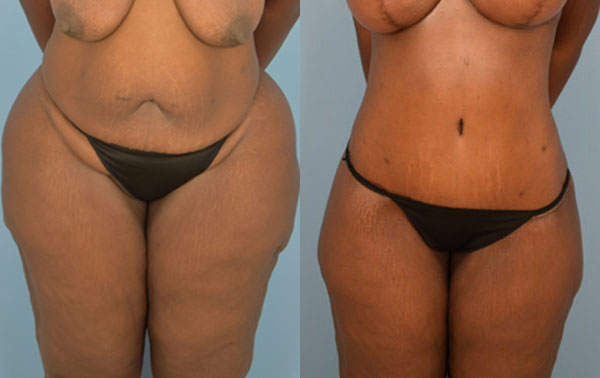 Photo of the patient’s body before & after the Body Lift surgery. Set 1: Patient 3