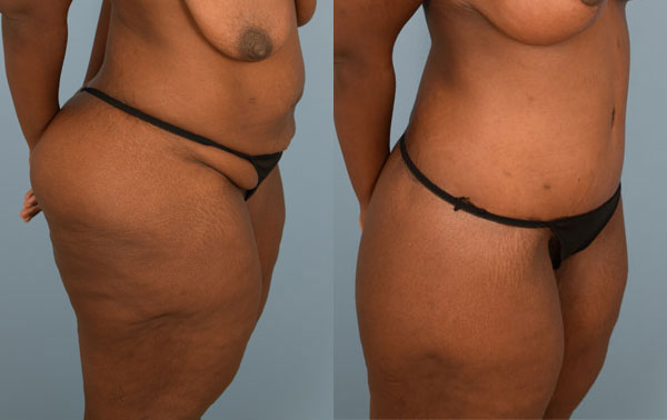 Photo of the patient’s body before & after the Body Lift surgery. Set 2: Patient 3