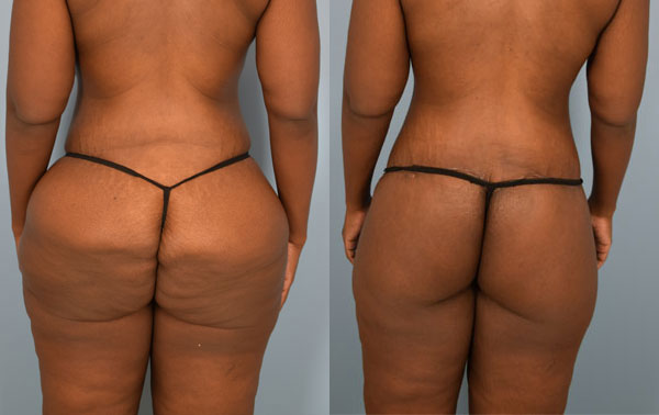 Photo of the patient’s body before & after the Body Lift surgery. Set 3: Patient 3