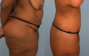 Body Lift Before & After Patient Miniature Set