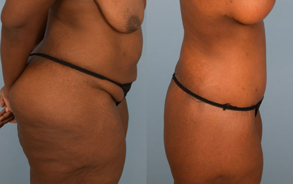 Photo of the patient’s body before & after the Body Lift surgery. Set 4: Patient 3
