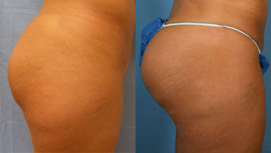 Photo of the patient’s body before & after the Brazilian Butt Lift surgery. Set 1: Patient 1