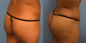 Photo of the patient’s body before & after the Brazilian Butt Lift surgery. Set 1: Patient 2