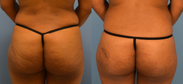 Photo of the patient’s body before & after the Brazilian Butt Lift surgery. Set 2: Patient 2