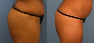 Brazilian Butt Lift Before & After Patient Miniature Set