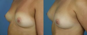 Breast Augmentation with Fat Before & After Patient Miniature Set