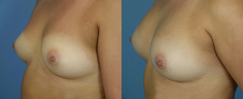 Photo of the patient’s body before & after the Breast Augmentation with Fat surgery. Set 2: Patient 1