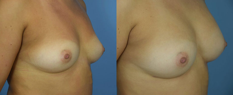 Photo of the patient’s body before & after the Breast Augmentation with Fat surgery. Set 3: Patient 1