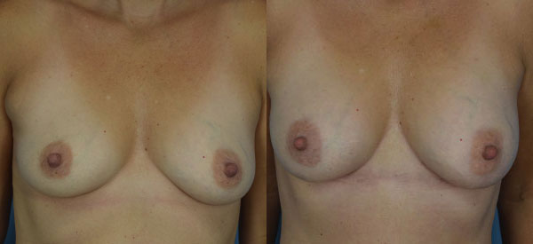 Photo of the patient’s body before & after the Breast Augmentation with Fat surgery. Set 1: Patient 2