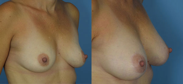 Photo of the patient’s body before & after the Breast Augmentation with Fat surgery. Set 2: Patient 2