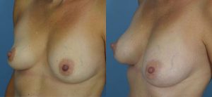 Breast Augmentation with Fat Before & After Patient Miniature Set