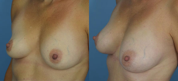 Photo of the patient’s body before & after the Breast Augmentation with Fat surgery. Set 3: Patient 2