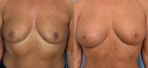 Breast Augmentation with Fat Before & After Patient3